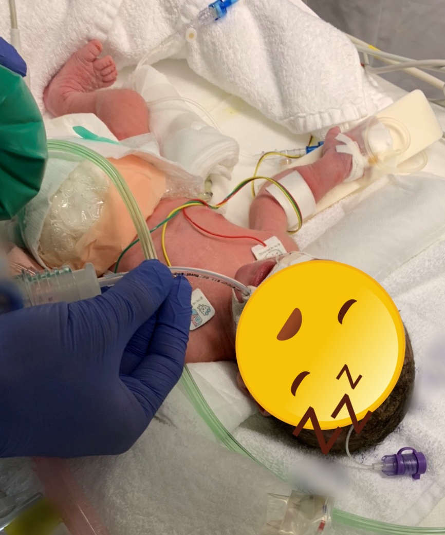 手術前の赤ちゃん